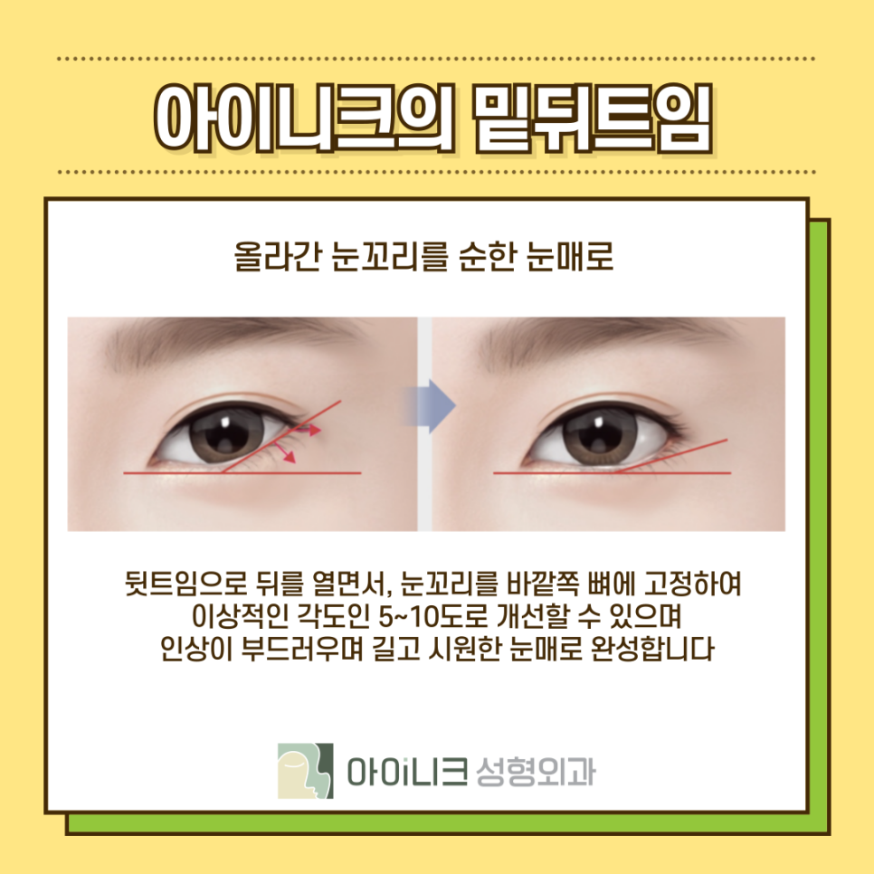 밑트임뒷트임 원하는 눈매에 맞게 진행하기 관련 이미지 11