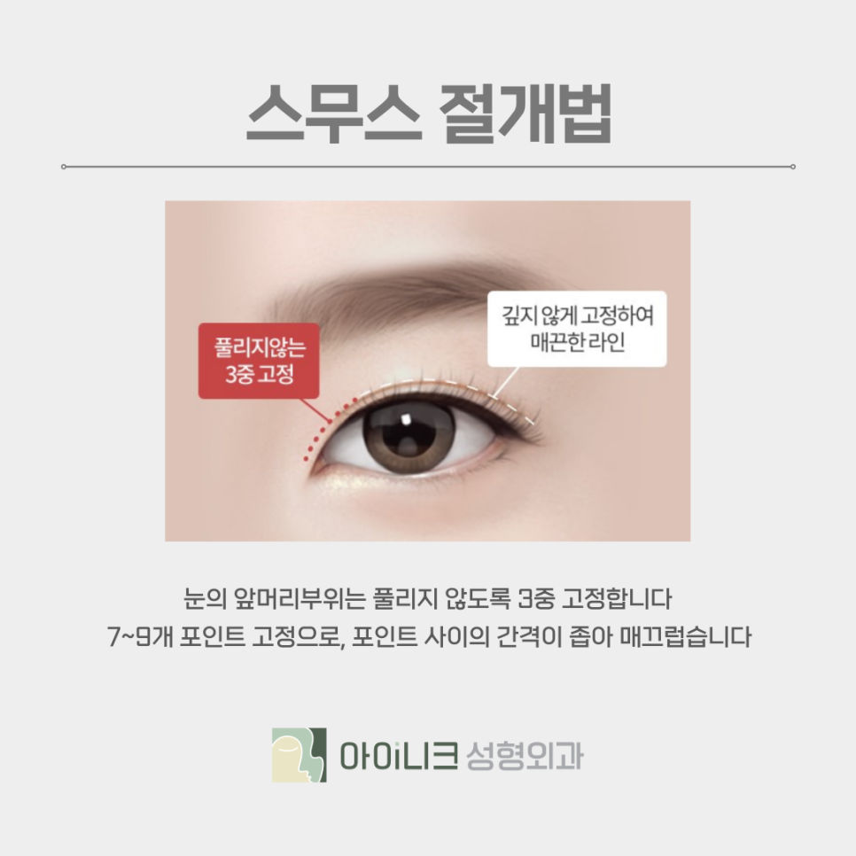 쌍꺼풀종류 본인의 눈 상태에 맞게 선택하기 관련 이미지 9