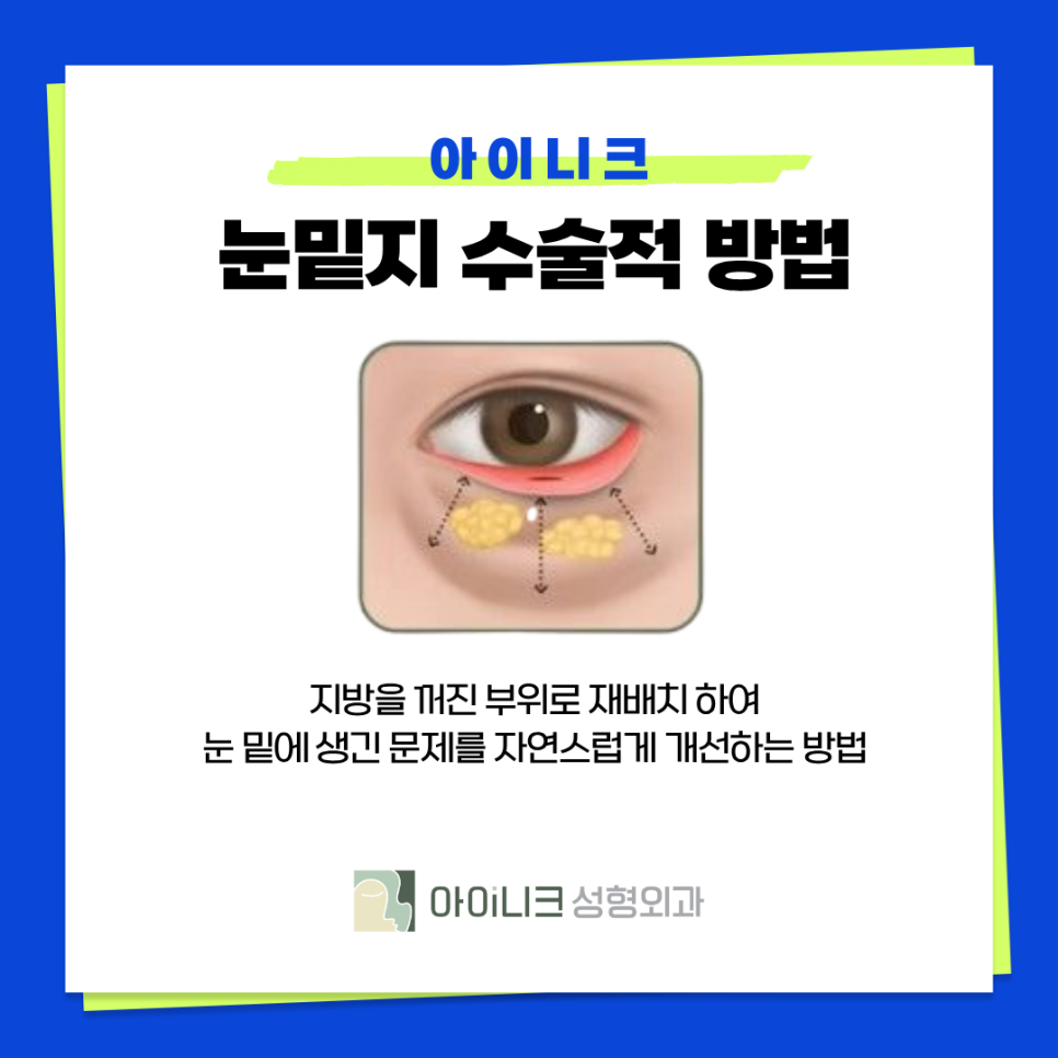 비수술눈밑지방재배치 어떻게 다를까? 관련 이미지 8
