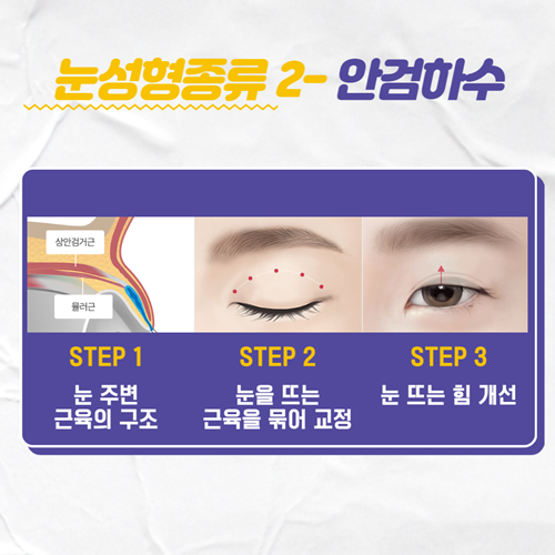 눈성형종류 중에 내게 맞는 방법은? 관련 이미지 3