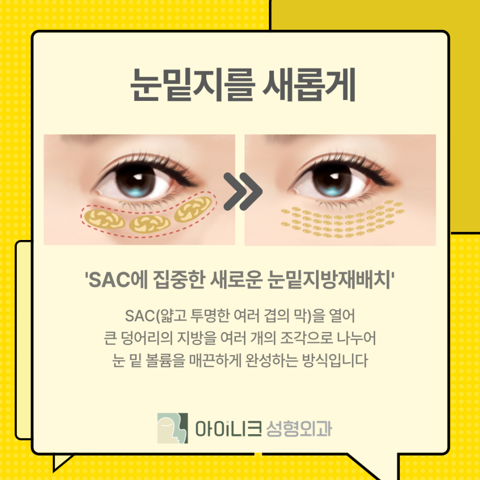 Improving a Drowsy, Lethargic Face with Encore Under-Eye Fat Repositioning image 9