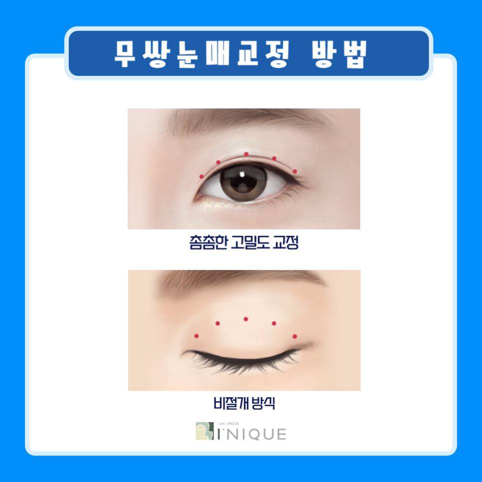 남자쌍꺼풀수술비용 보다 중요한 것은? 관련 이미지 5