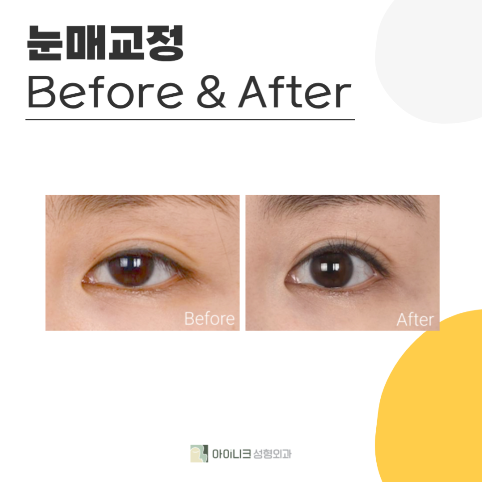 처진눈꺼풀개선이 필요하다면 주목! 관련 이미지 5