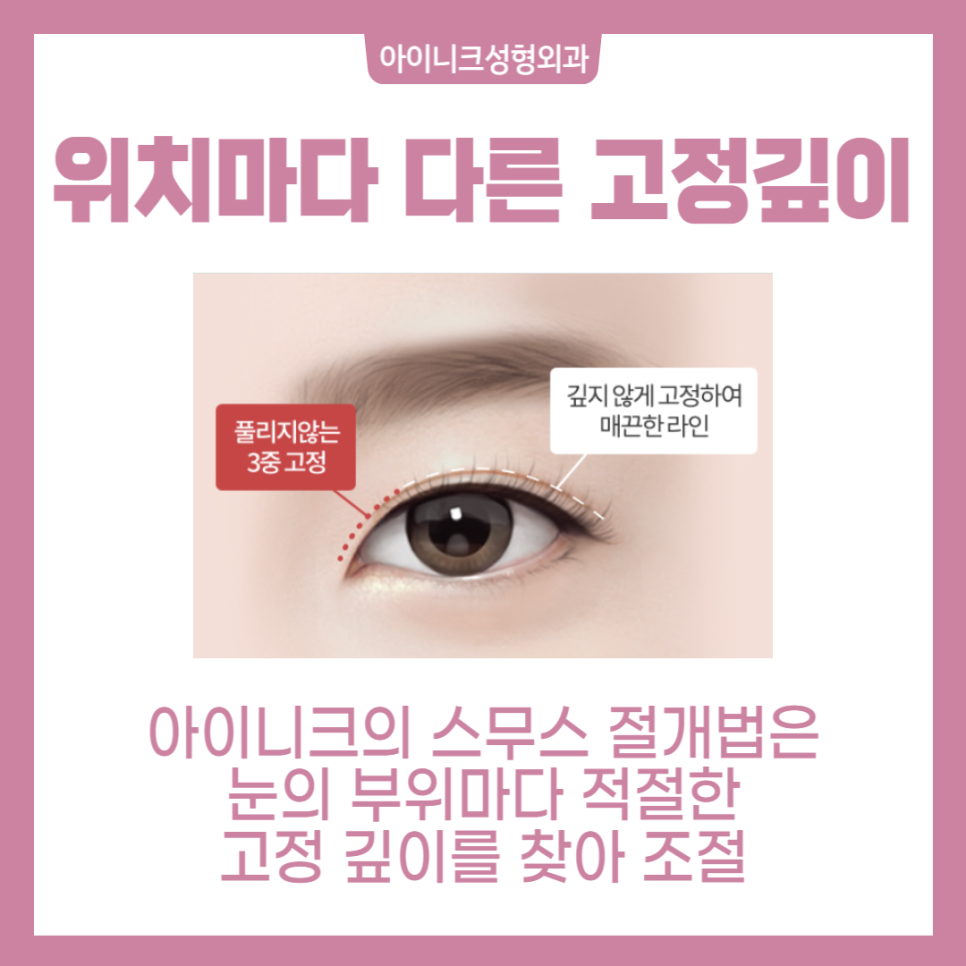 작은눈수술, 자연스러운 쌍꺼풀라인으로 관련 이미지 4