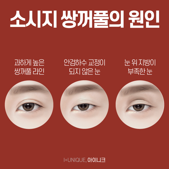 What Should You Do About Uncomfortable Sausage-Like Double Eyelids? image 2