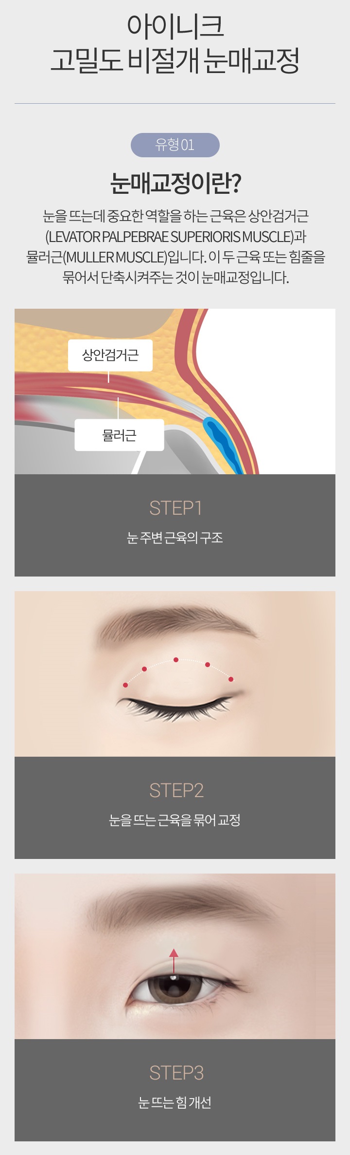 비절개눈매교정부작용 걱정없는 수술은? 관련 이미지 3