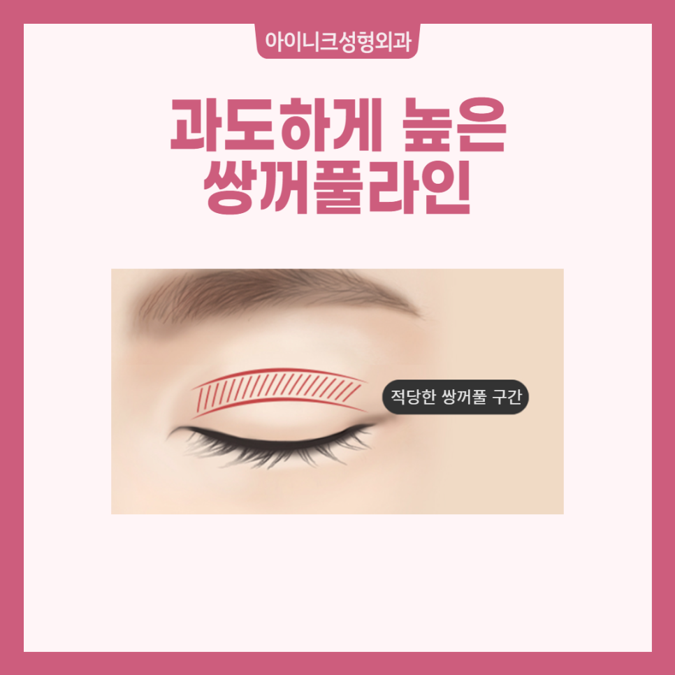 Take a Careful Look at an Apgujeong Eye Revision Surgery Clinic! image 2