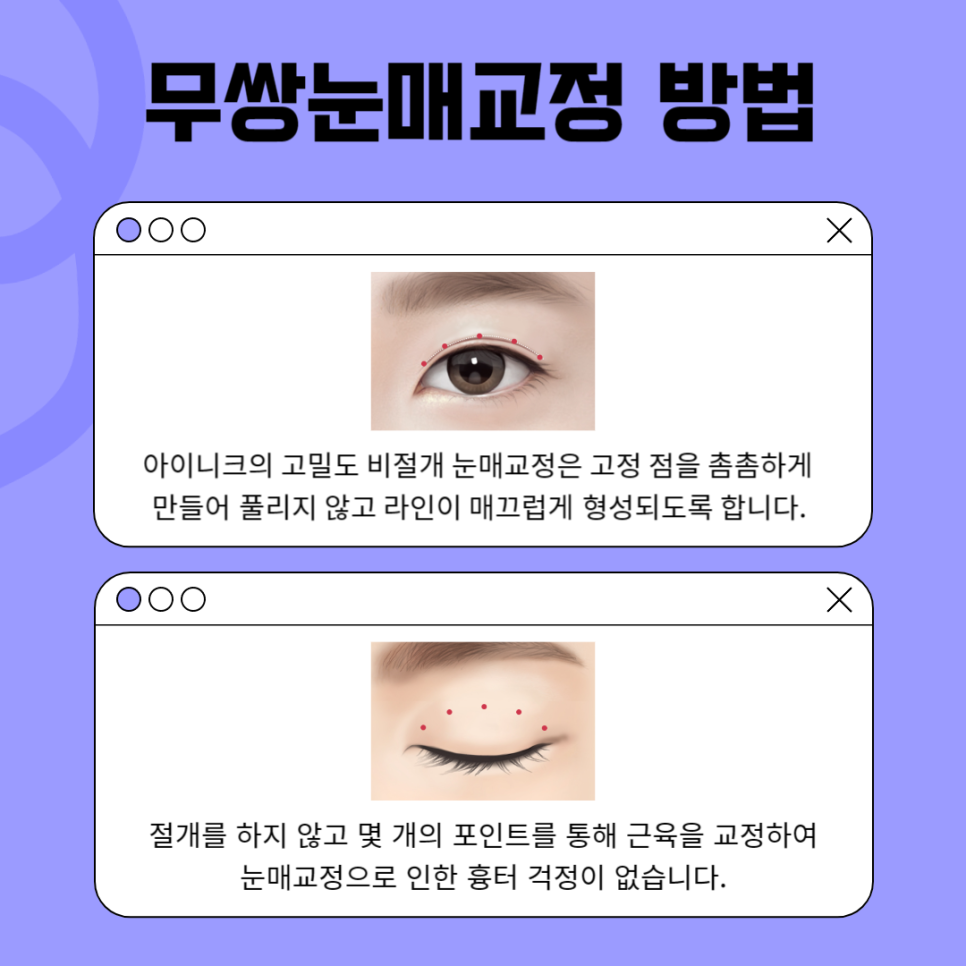 남자 눈매교정 붓기 없이 성공하기 관련 이미지 4