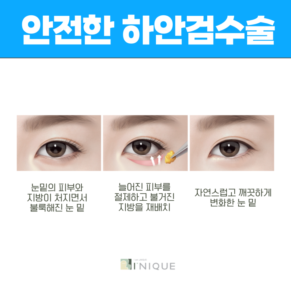 중년성형외과 안전함과 완성도를 갖춘 이곳 관련 이미지 3