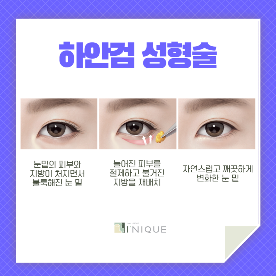 Double Eyelid Surgery in Your 40s, This Is the Perfect Option for Middle Age! image 4