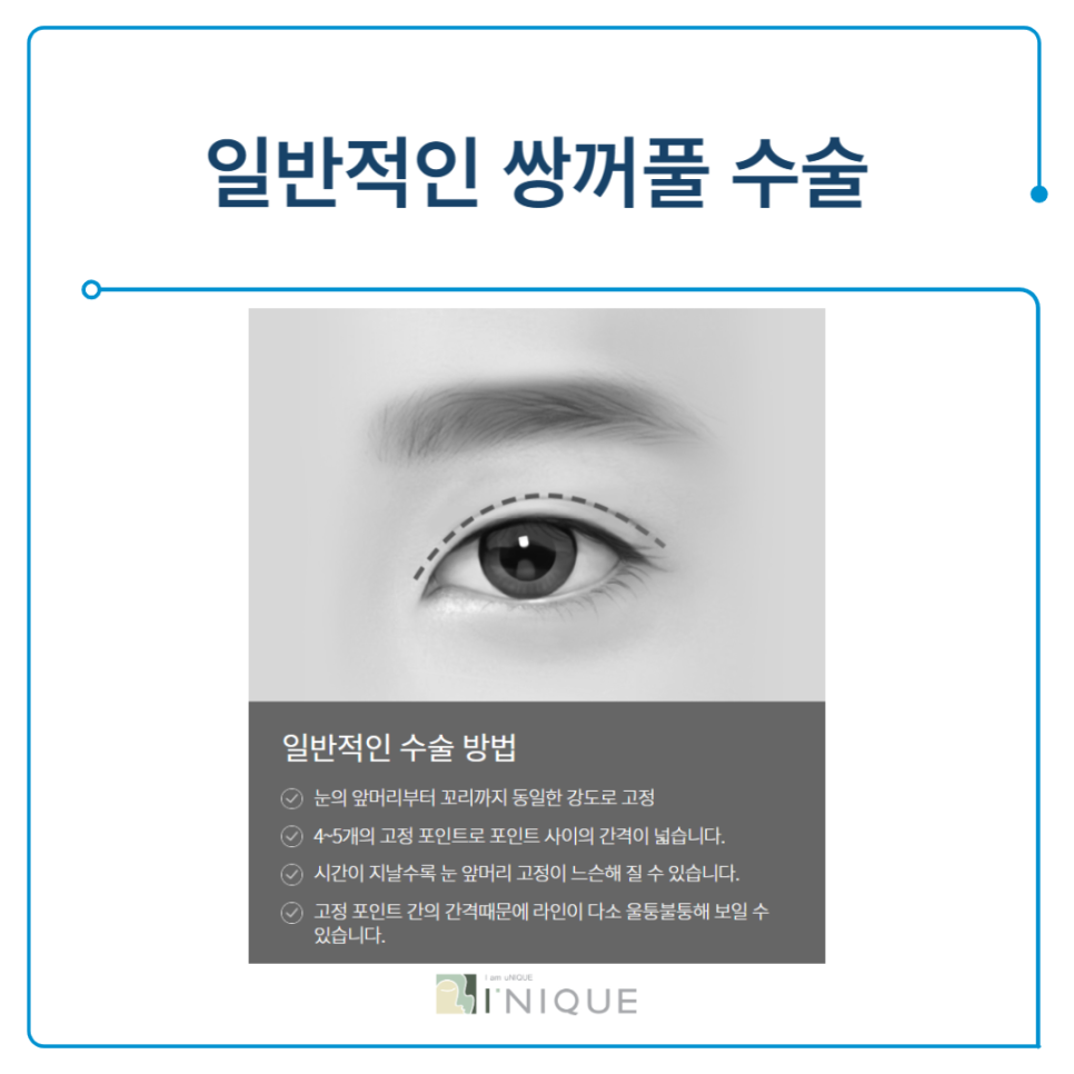 눈크게하는수술 절개법이란? 관련 이미지 3