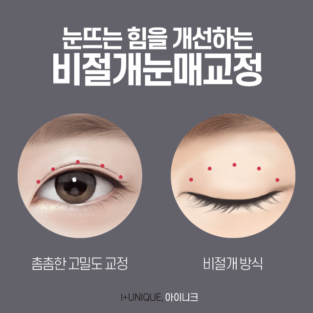 서울눈재수술추천 아이니크 성형외과에서 제대로 성공하자. 관련 이미지 4