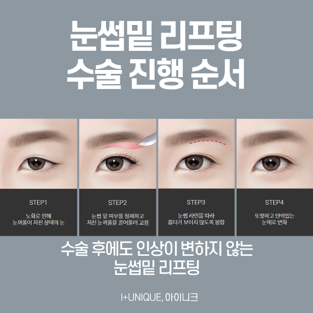 효도성형, 안전하게 해야죠! 관련 이미지 3
