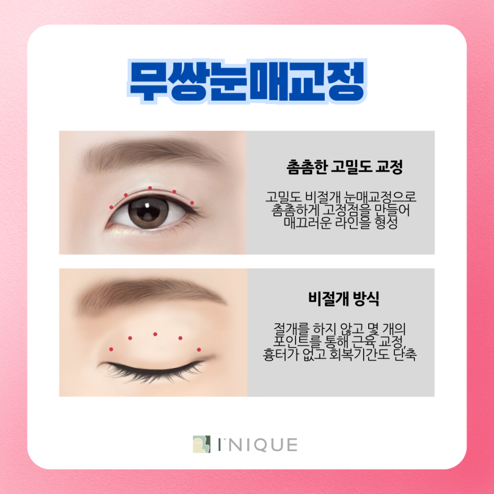 Apgujeong Male Eye Surgery: What’s the Difference from Women’s? image 7