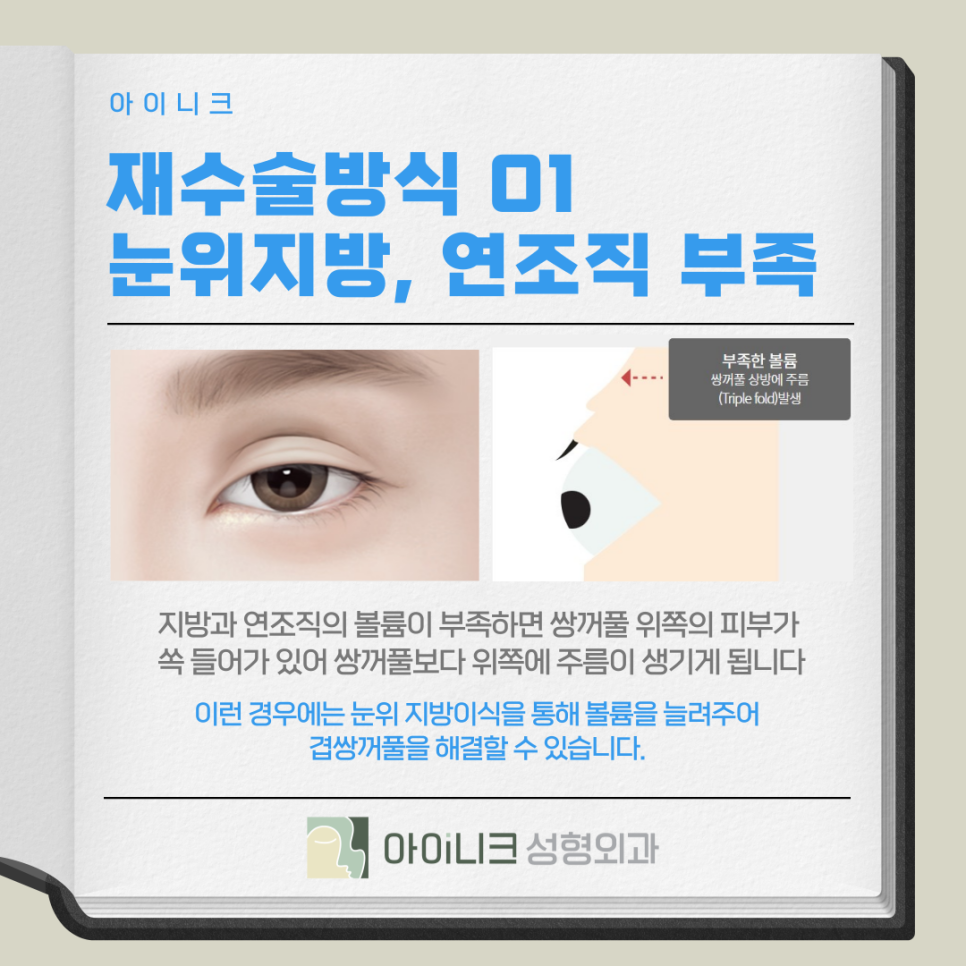 겹쌍꺼풀 여러 개의 주름이 생기는 증상일까요? 관련 이미지 8