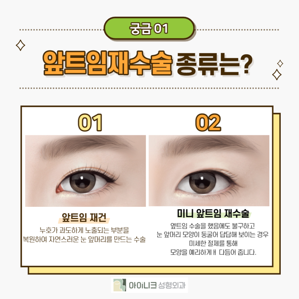 Let’s Take a Proper Look at Revision Eye Surgery! image 2