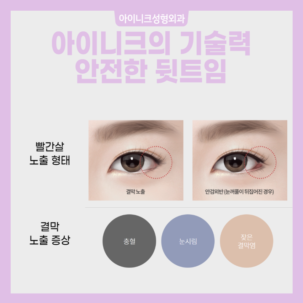 눈트임성형 자연스럽고 아름답게! 관련 이미지 4