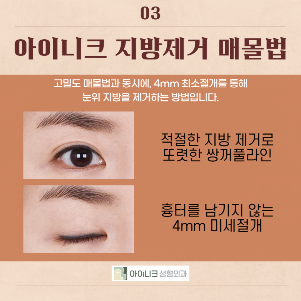 강남눈수술, 이곳이 답! 관련 이미지 5