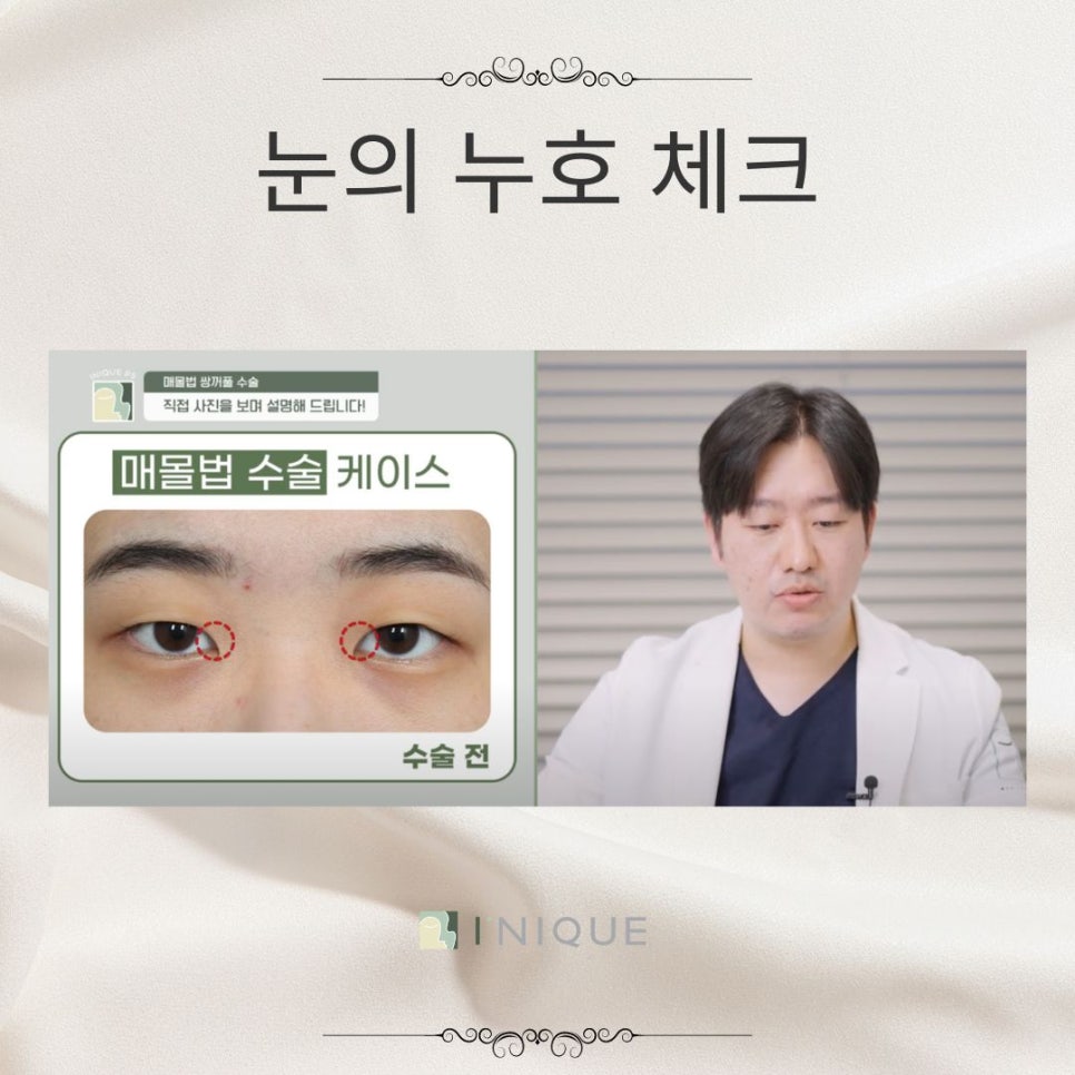여자눈매몰법 고려해야하는 점 관련 이미지 2