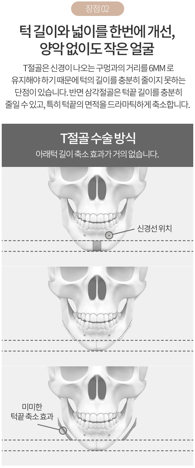 턱끝축소술부작용 없이 안전한 수술 관련 이미지 5