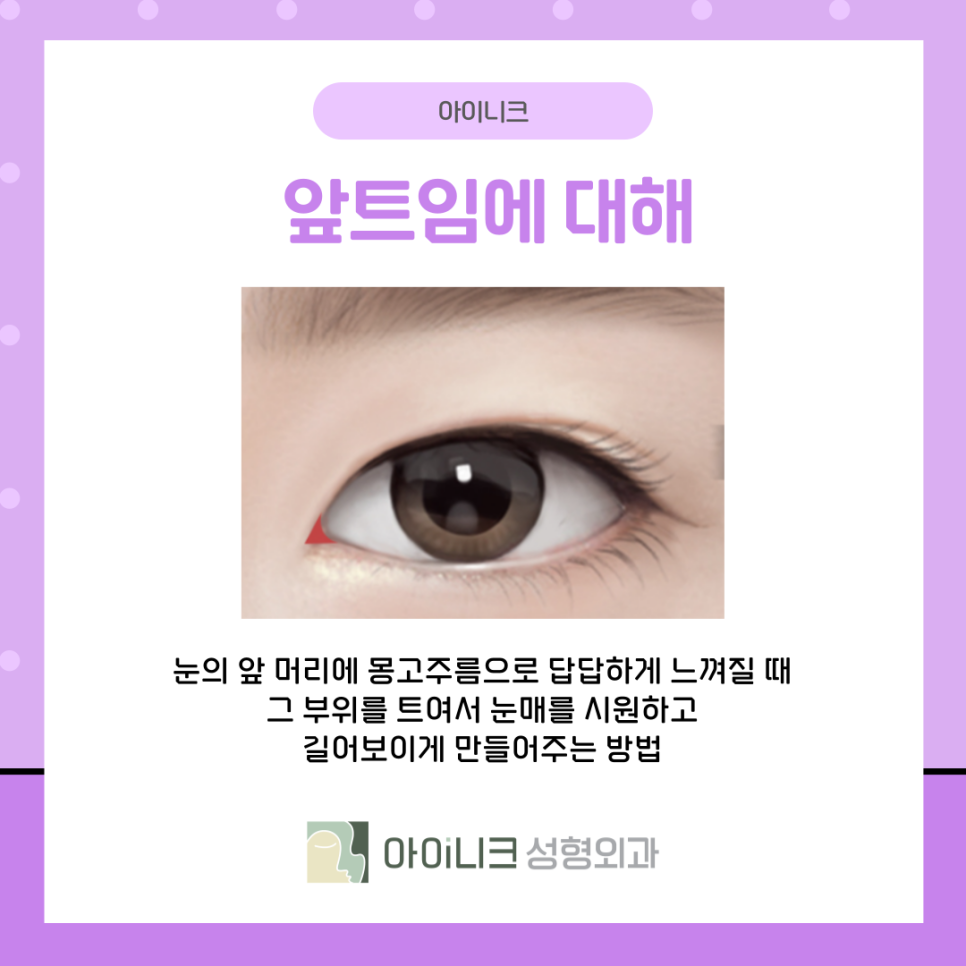 앞트임눈매교정 과하지 않고 자연스럽게 관련 이미지 5
