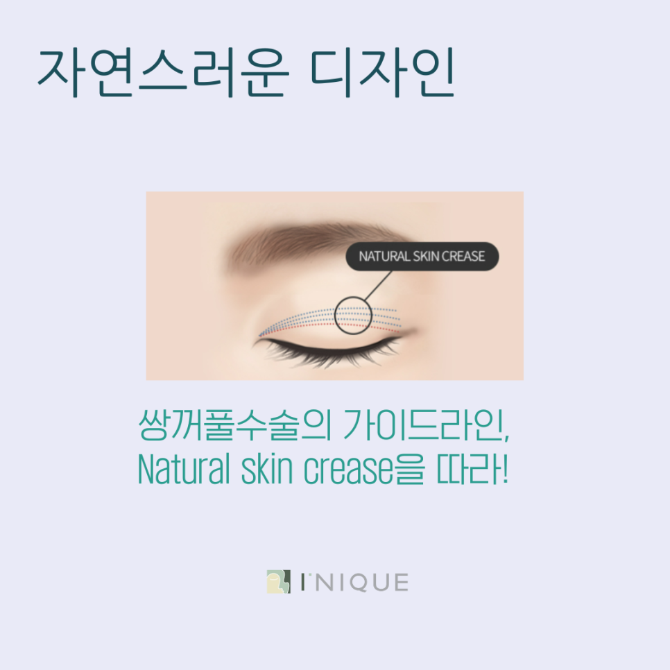 쌍수성형 잘하는 곳 선택하는 방법 관련 이미지 6