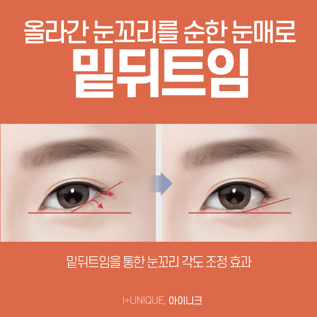 안전한 앞, 뒤트임복원 수술로 새롭게 태어나세요! 관련 이미지 4