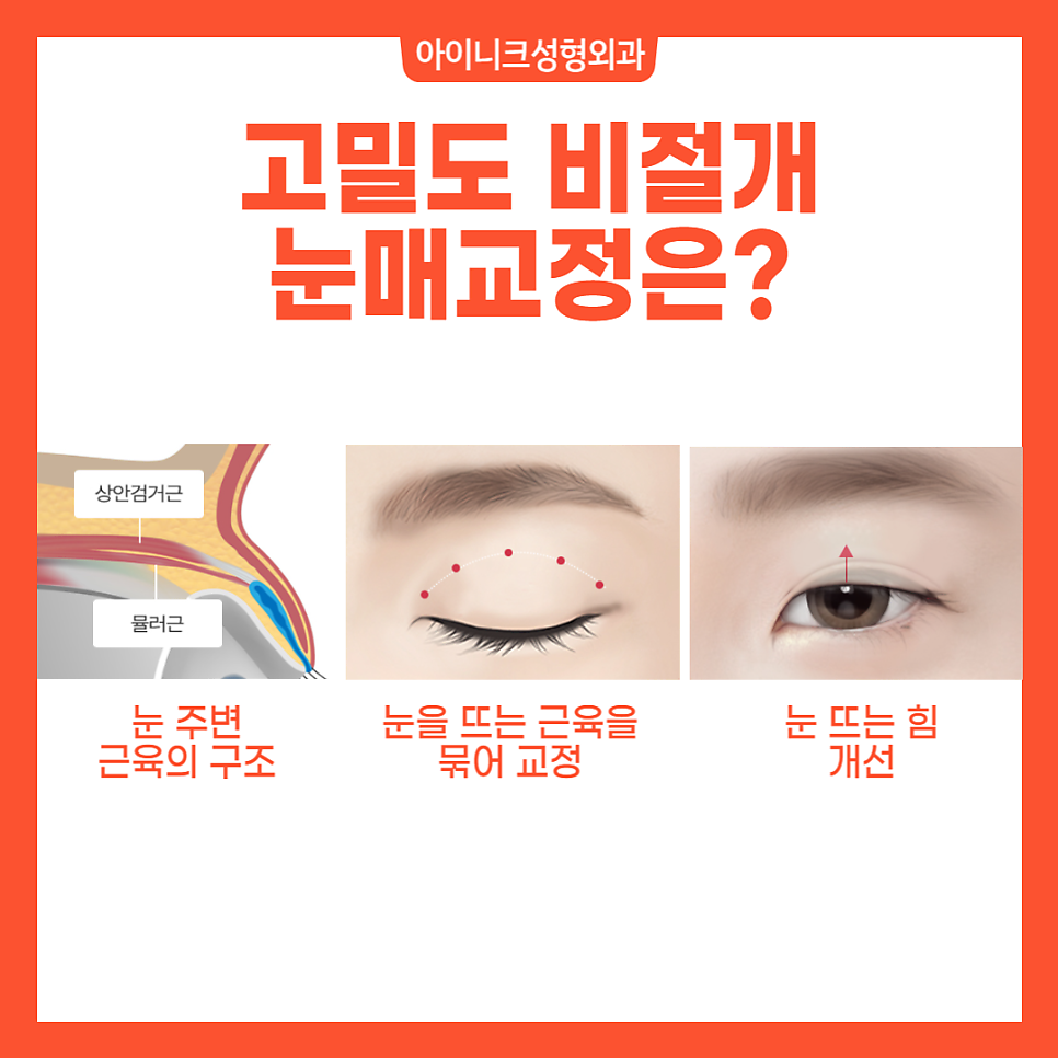 Apgujeong Ptosis: Correct It Without Incision! image 4