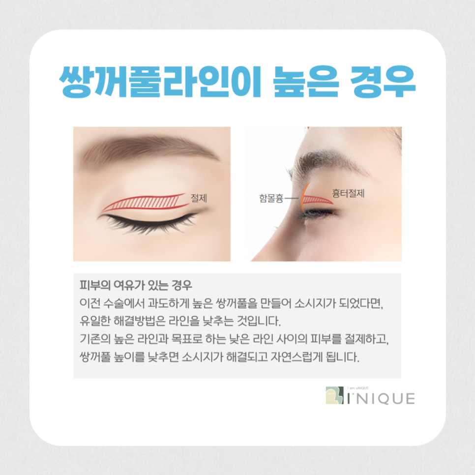 눈성형재수술, 마지막이 되려면? 관련 이미지 4