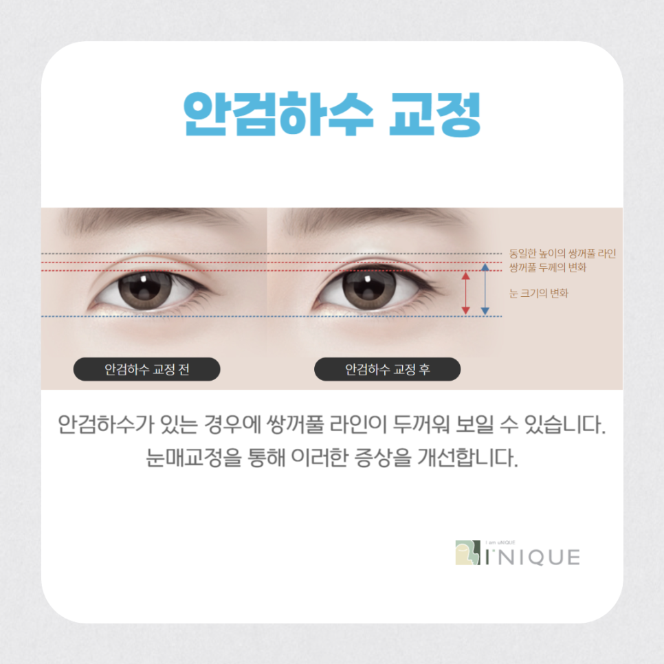 눈성형재수술, 마지막이 되려면? 관련 이미지 6