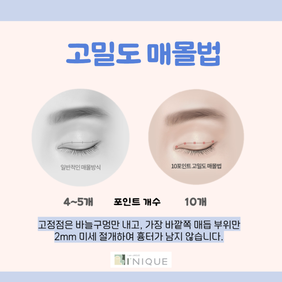 눈쌍꺼풀수술 나에게 맞는 수술은? 관련 이미지 3