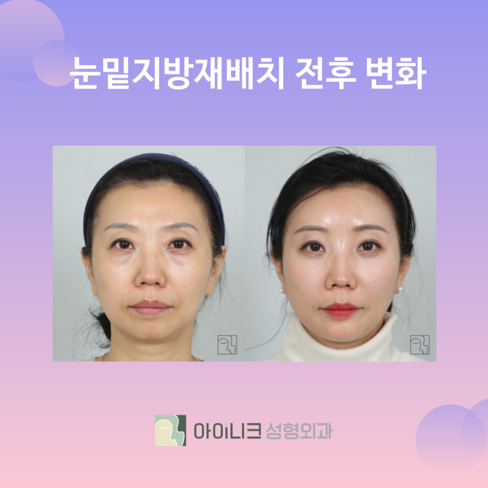 눈밑지방재배치 10년은 더 젊어 보이게 관련 이미지 6