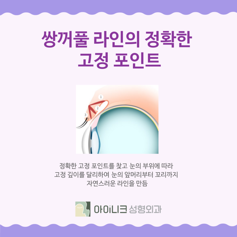 강남눈수술 쌍꺼풀은 자연스러운 디자인이 중요 관련 이미지 6
