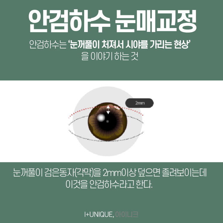 눈수술잘하는병원을 찾고 있다면 고민말고 아이니크성형외과로 관련 이미지 2