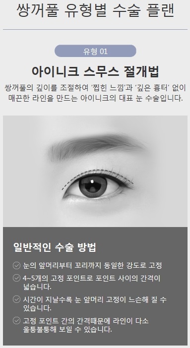 쌍수절개법 특별한 노하우 공개 관련 이미지 3