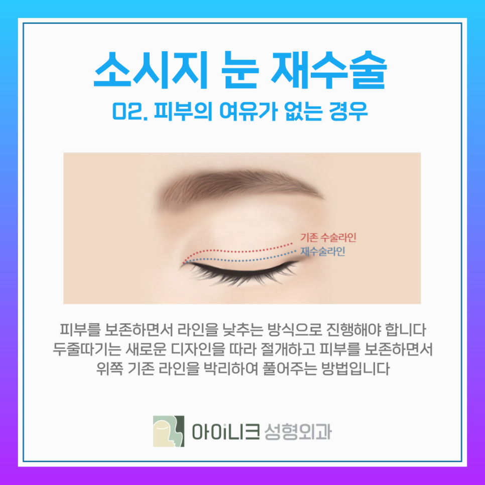 눈재수술비용 보다 중요한 소시지 쌍꺼풀 개선방식 관련 이미지 10