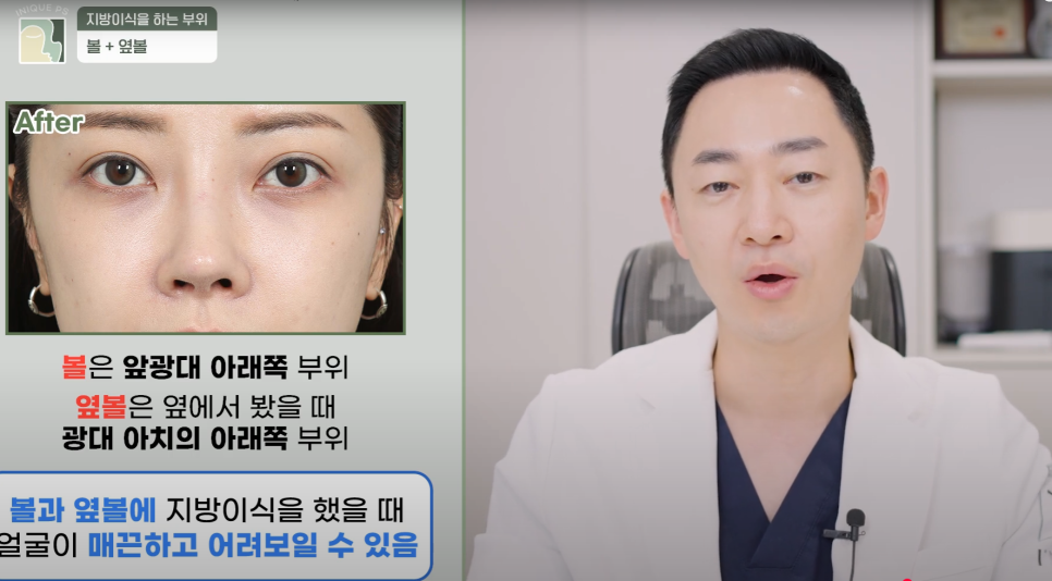 Look Younger with Gangnam Encore Under-Eye Fat Grafting! image 11