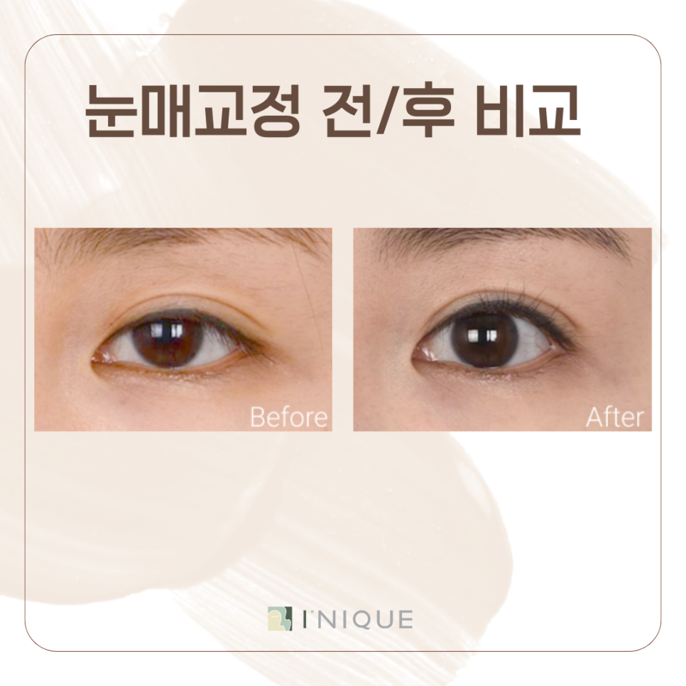 남성눈성형 느끼하지 않은 깔끔한 인상으로 관련 이미지 6