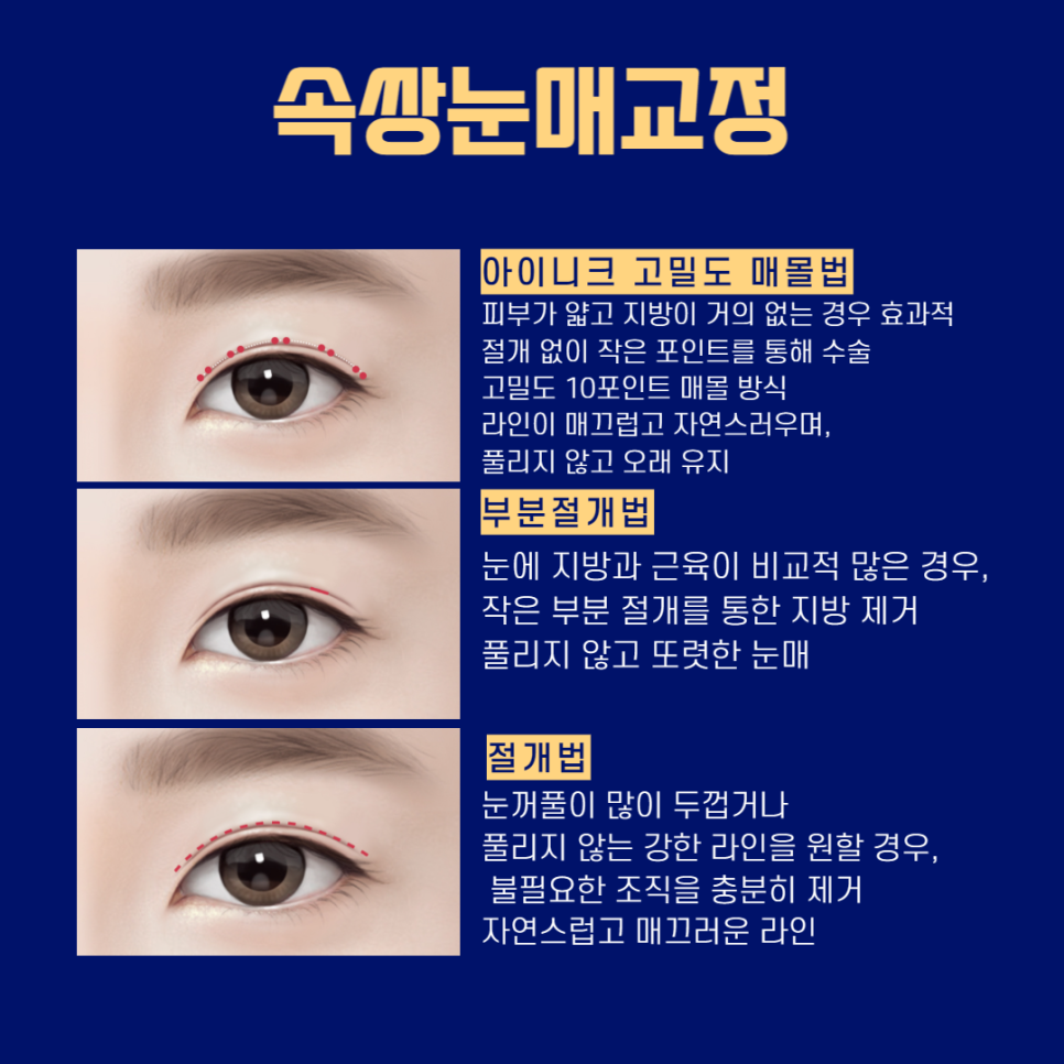 남자눈성형잘하는곳, 자연스럽고 또렷한 눈! 관련 이미지 3