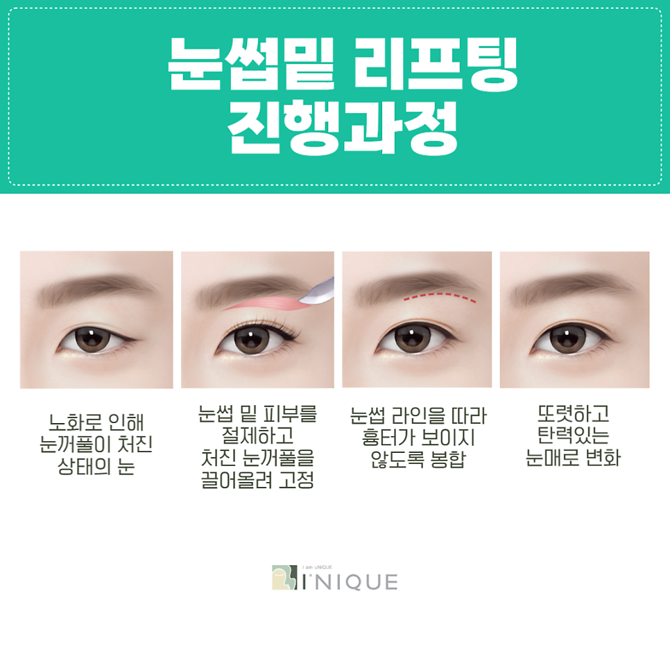 Is Double Eyelid Surgery in Your 50s the Right Choice? image 2