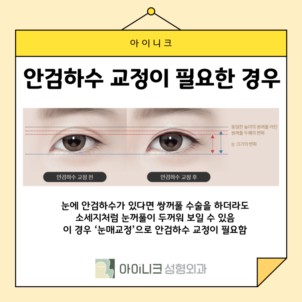 How Can Sausage-Eye Revision Surgery Be Done Naturally? image 9
