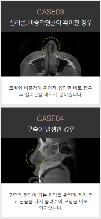 코보형물종류 나에게 맞는 걸로 선택하자 관련 이미지 3