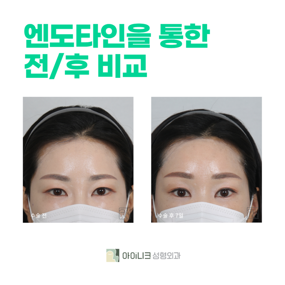 Brow Lift Surgery Improved to Create a Clearer Impression image 6