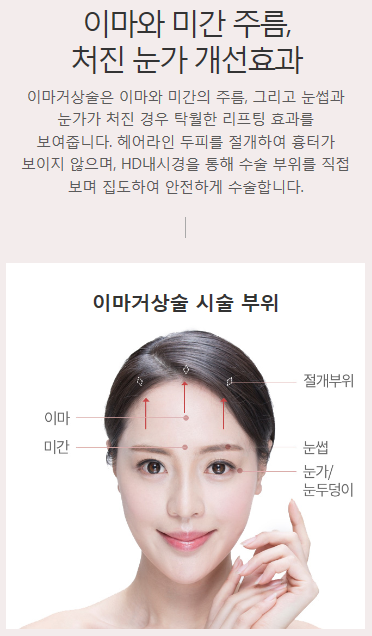 눈썹거상술 필요하신가요? 관련 이미지 2