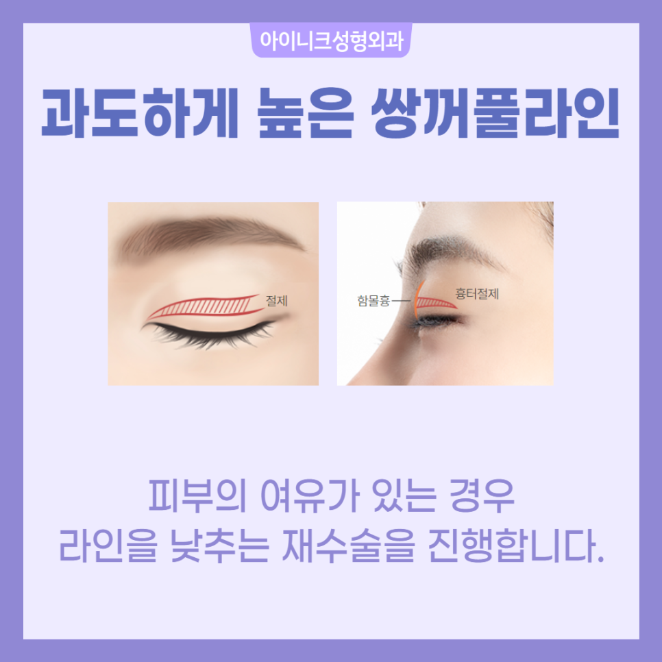 소세지쌍꺼풀 재수술 걱정 마세요! 관련 이미지 4