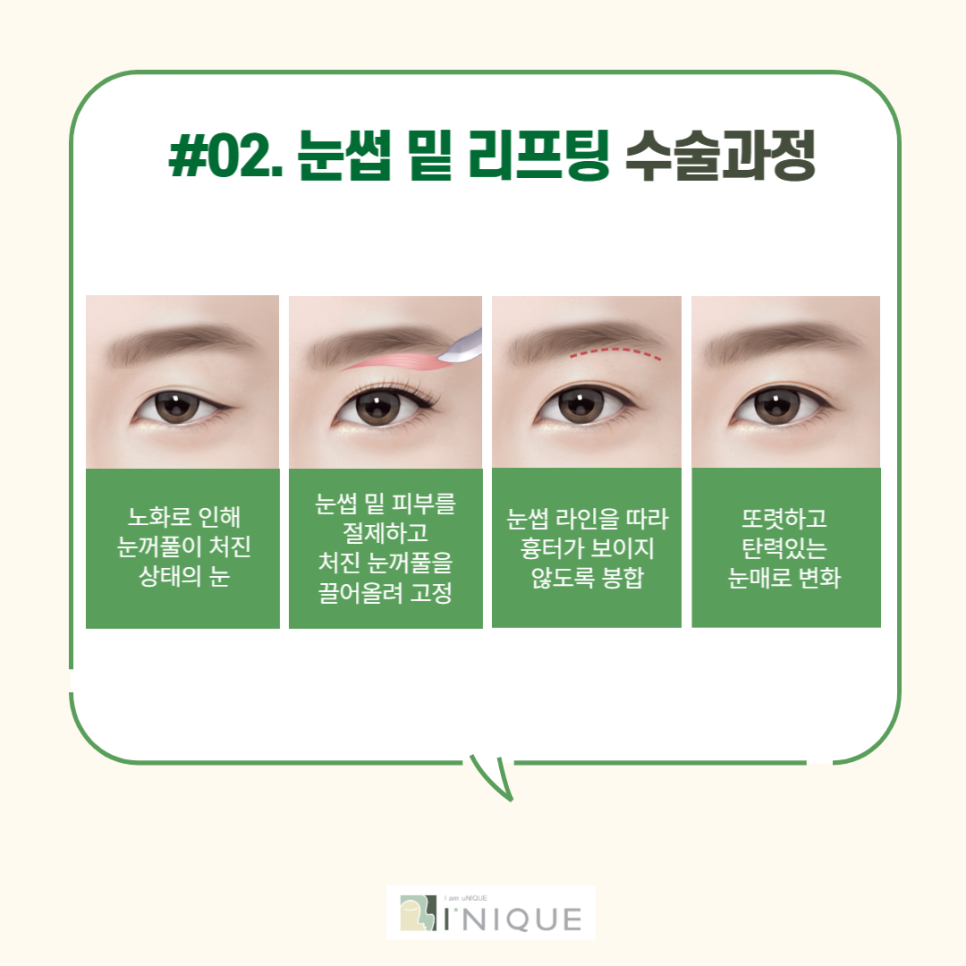 중년눈성형을 통해 다시 젊고 자신있게! 관련 이미지 3