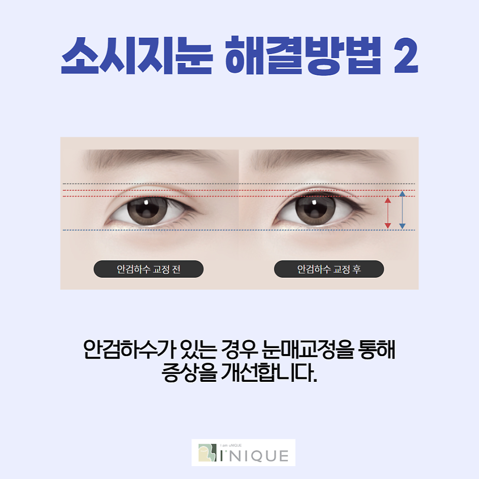 How to Naturally Lower the Double Eyelid Line image 4