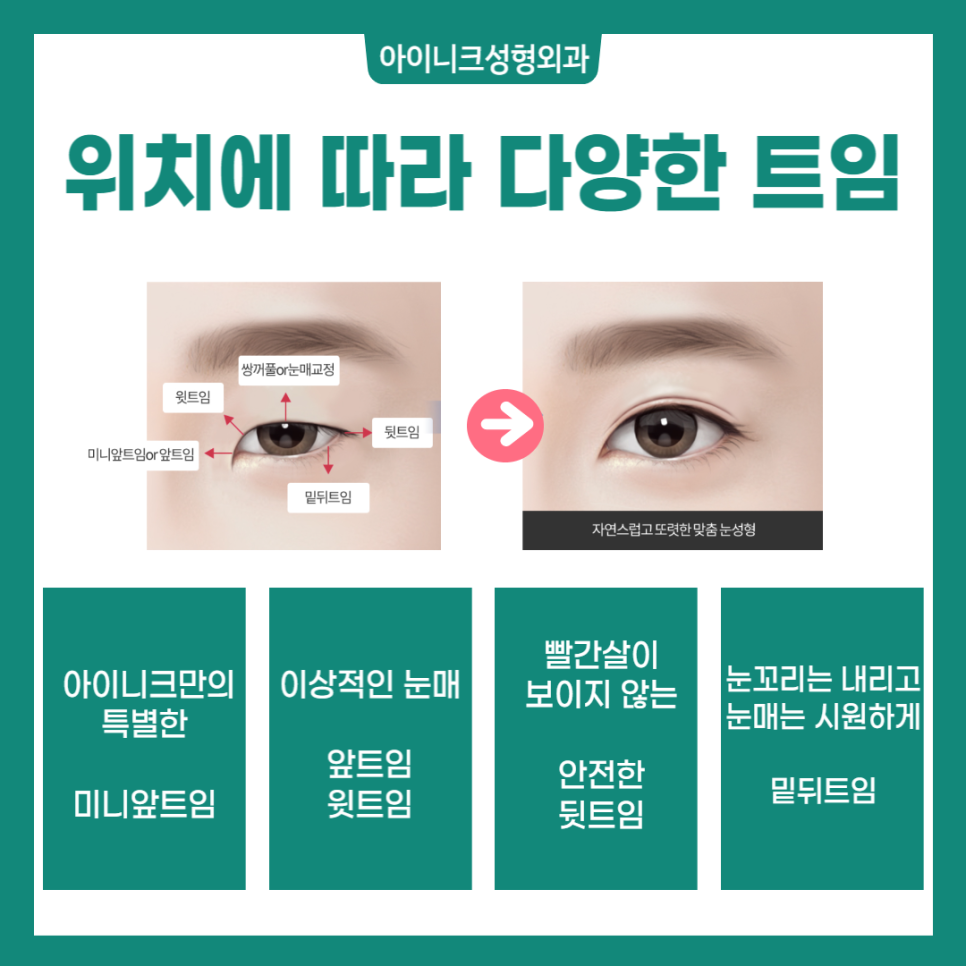 뒤트임잘하는곳 찾고 있나요? 관련 이미지 2