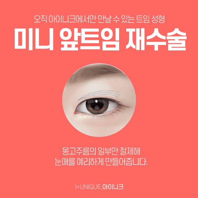앞트임재수술로 자연스러운 눈 만들자! 관련 이미지 4