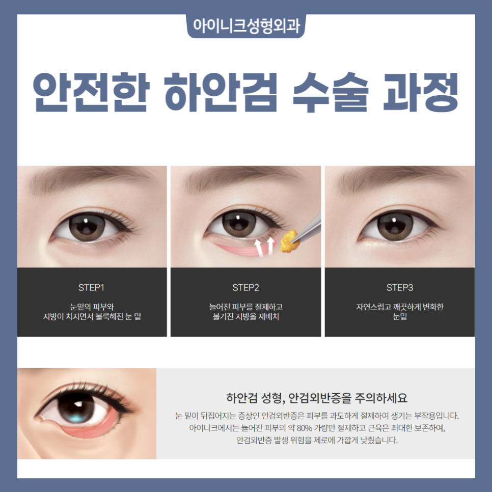 중년눈성형 고민이라면? 관련 이미지 5